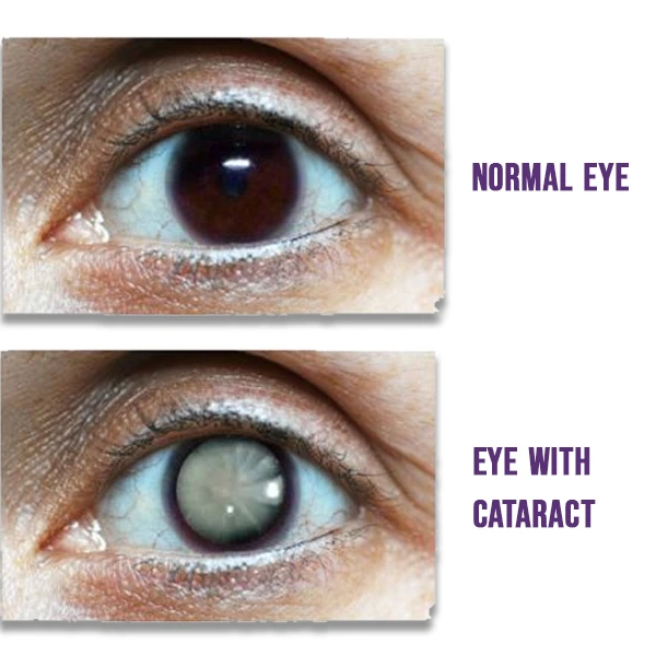 Diagram showing cataract causing clouding of natural eye lens